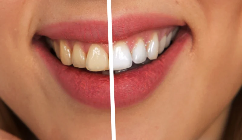 teeth whitening